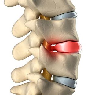 disque intervertébral- soulager un torticolis